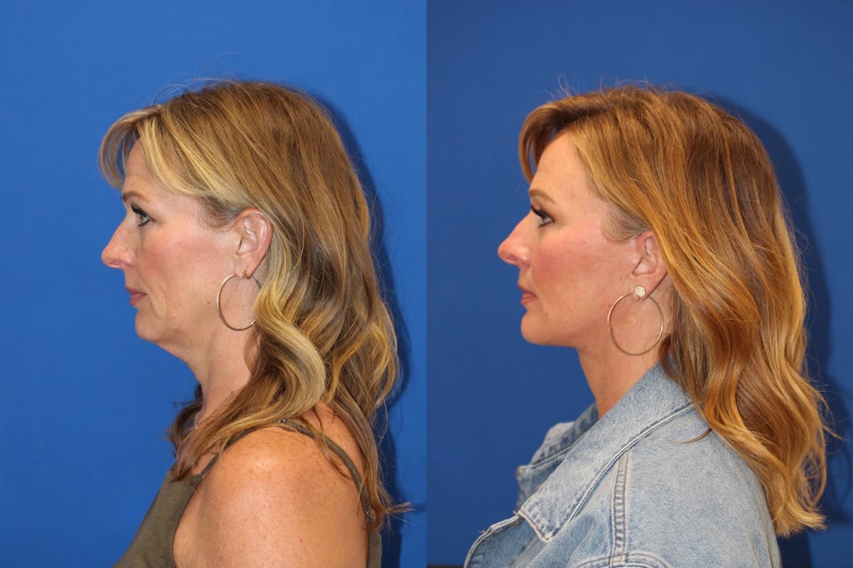 Vertical Restore® / Facial Rejuvenation Before & After Gallery - Patient 153265725 - Image 3