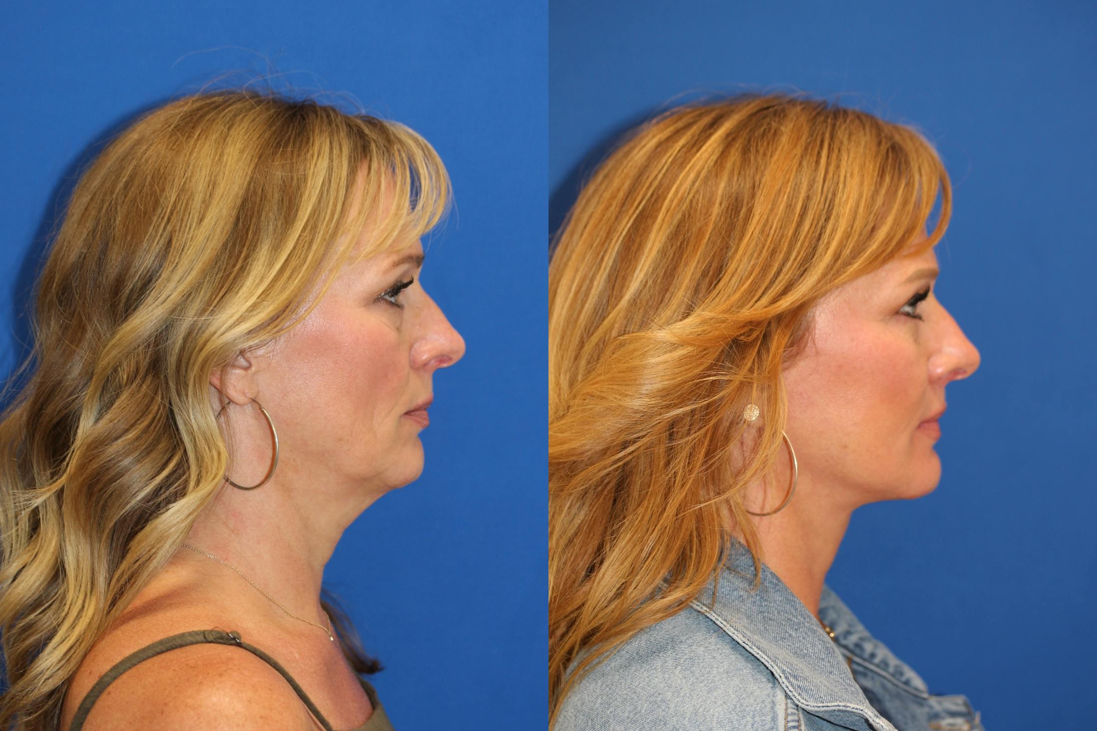 Vertical Restore® / Facial Rejuvenation Before & After Gallery - Patient 153265725 - Image 5