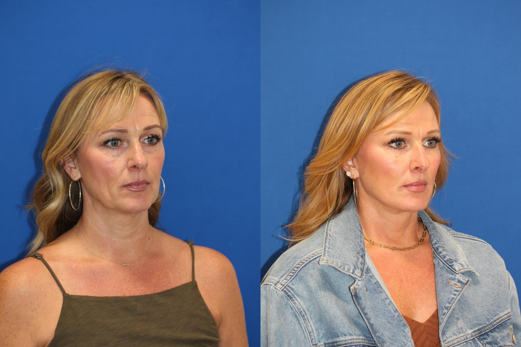 Vertical Restore® / Facial Rejuvenation Before & After Gallery - Patient 153265725 - Image 4