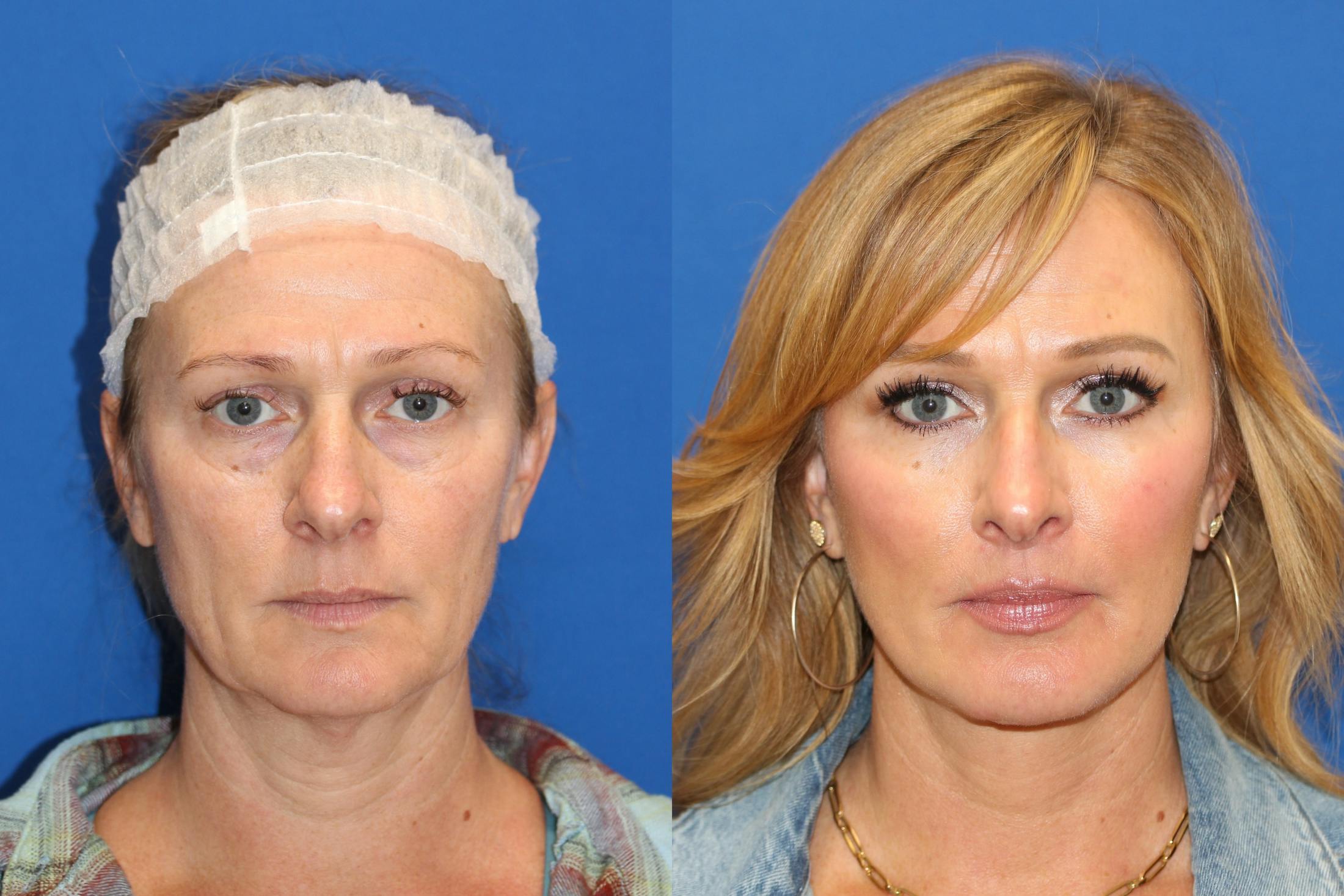 Vertical Restore® / Facial Rejuvenation Before & After Gallery - Patient 153265725 - Image 6