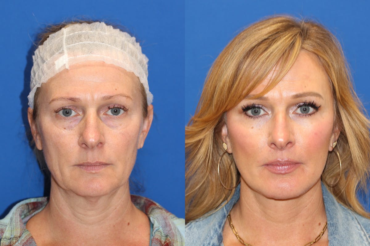 Vertical Restore® / Facial Rejuvenation Before & After Gallery - Patient 153265725 - Image 6
