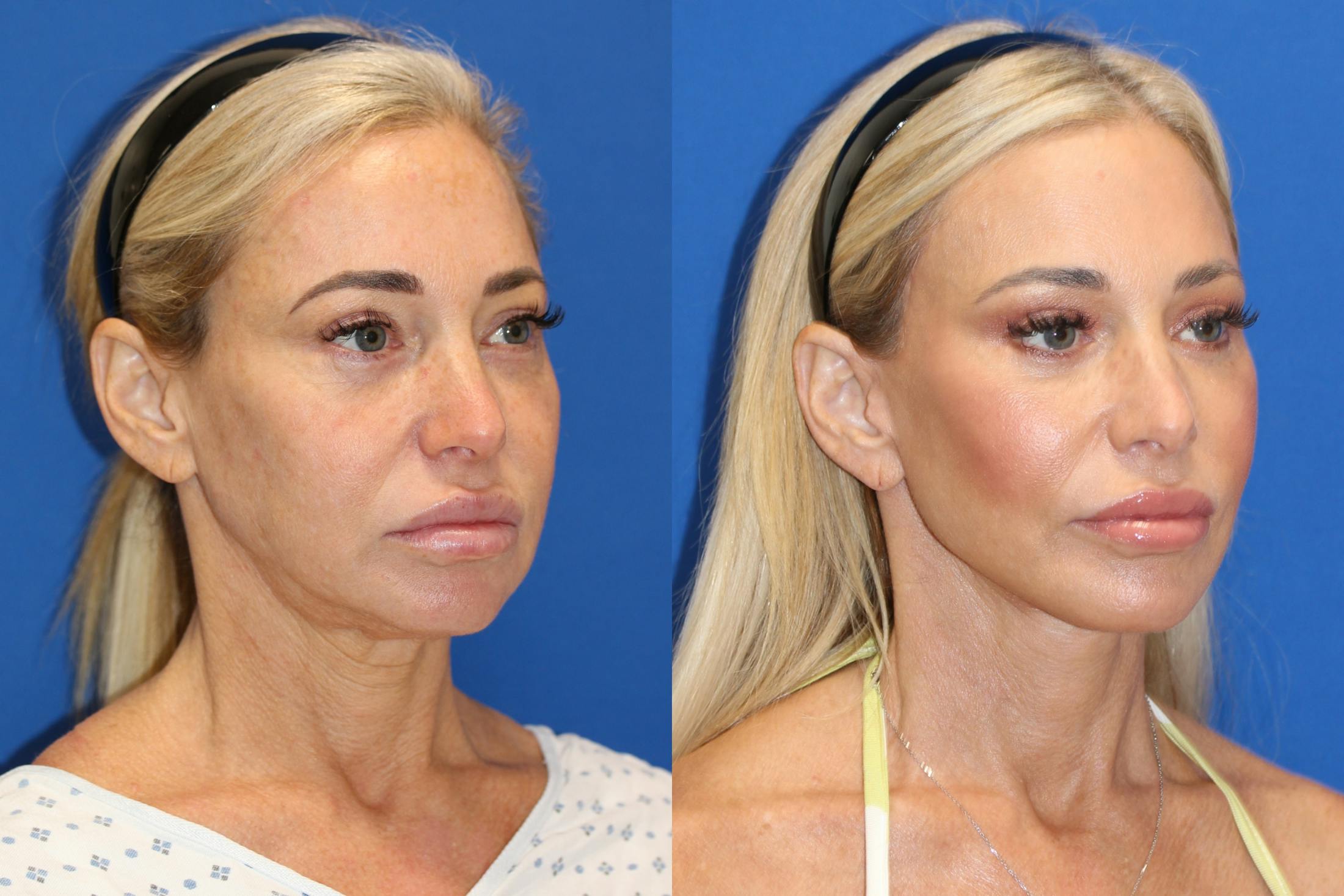 Vertical Restore® / Facial Rejuvenation Before & After Gallery - Patient 153265726 - Image 2