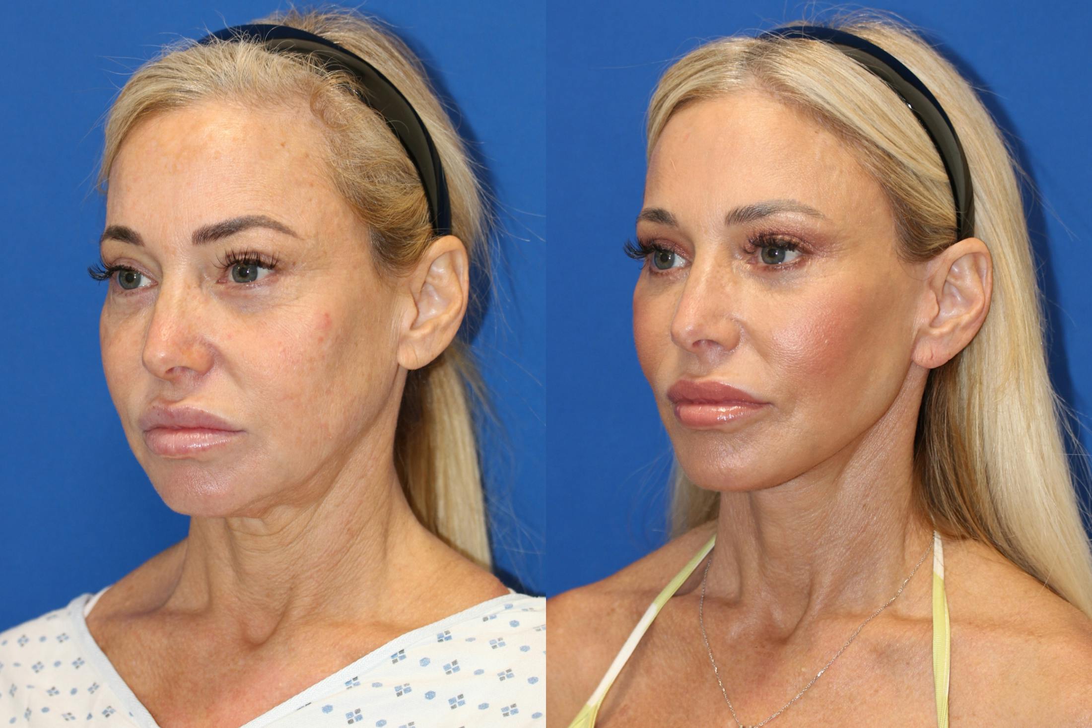 Vertical Restore® / Facial Rejuvenation Before & After Gallery - Patient 153265726 - Image 3
