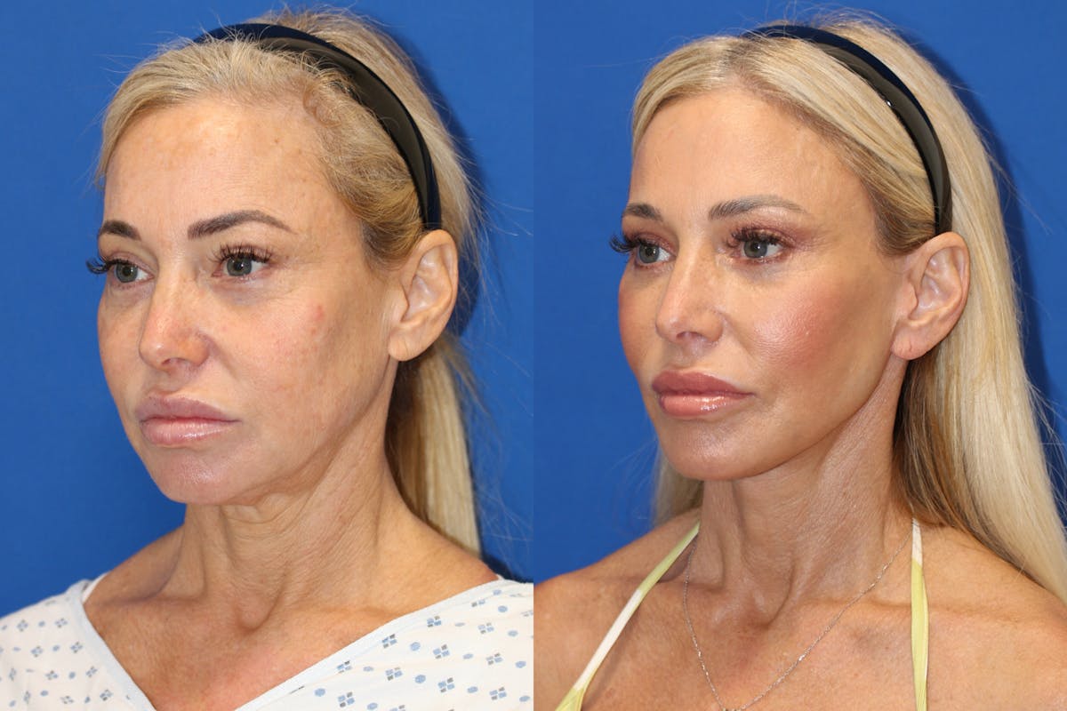 Vertical Restore® / Facial Rejuvenation Before & After Gallery - Patient 153265726 - Image 3