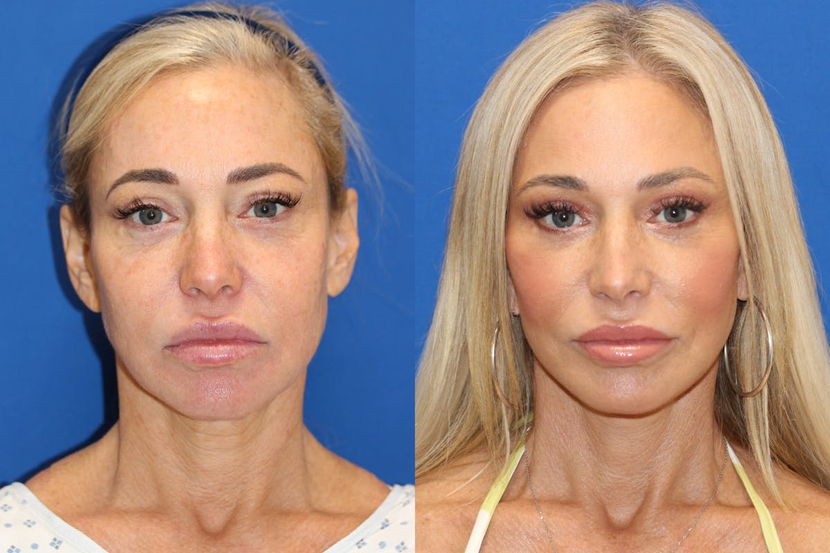 Vertical Restore® / Facial Rejuvenation Before & After Gallery - Patient 153265726 - Image 1