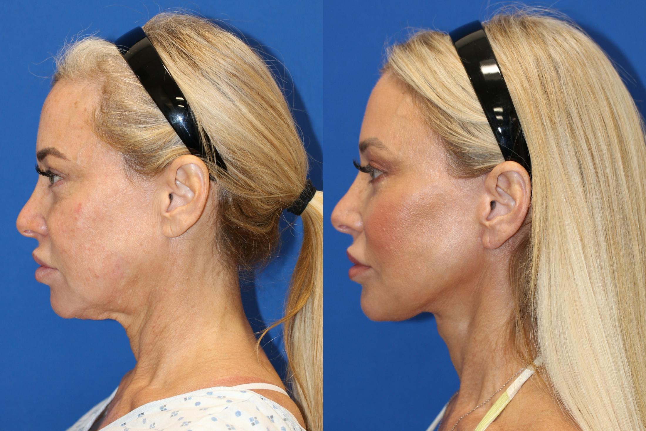 Vertical Restore® / Facial Rejuvenation Before & After Gallery - Patient 153265726 - Image 4