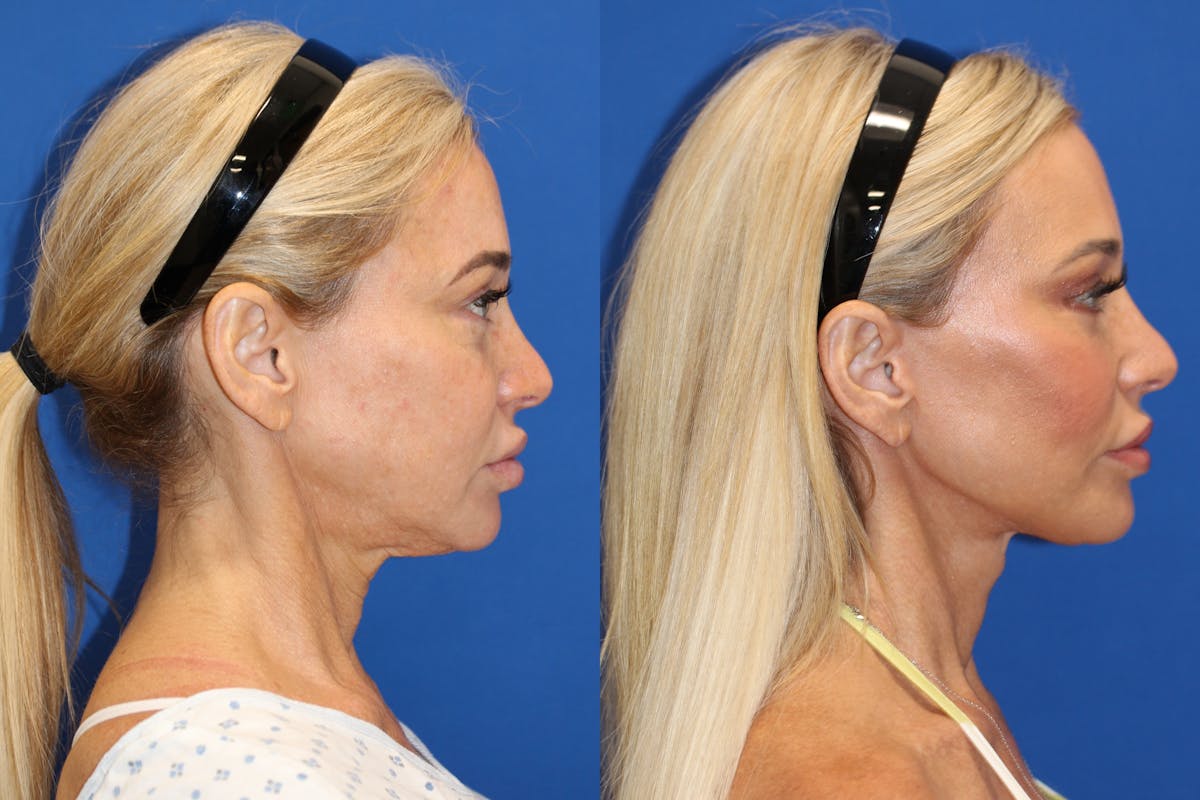 Vertical Restore® / Facial Rejuvenation Before & After Gallery - Patient 153265726 - Image 5
