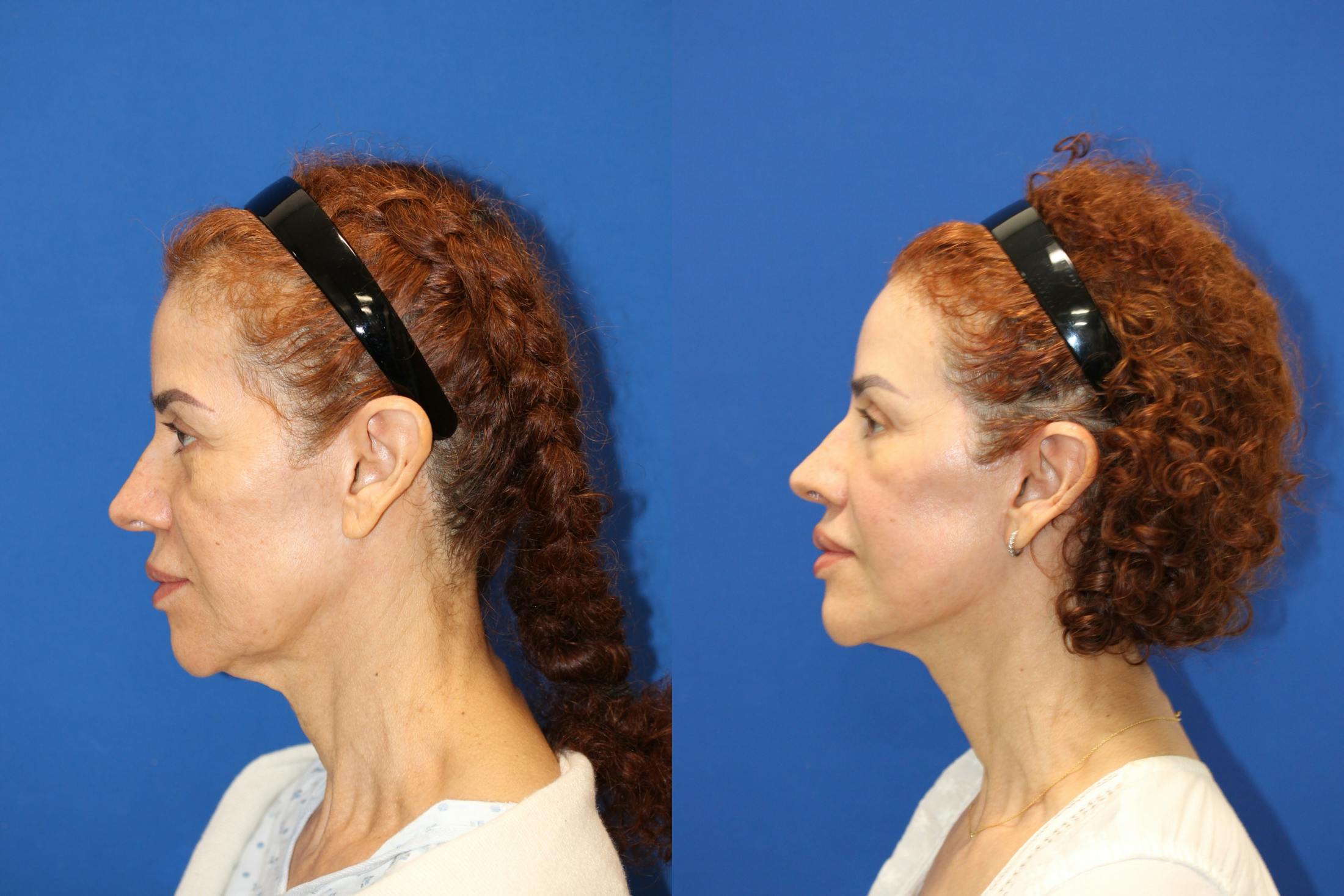 Vertical Restore® / Facial Rejuvenation Before & After Gallery - Patient 153265762 - Image 5
