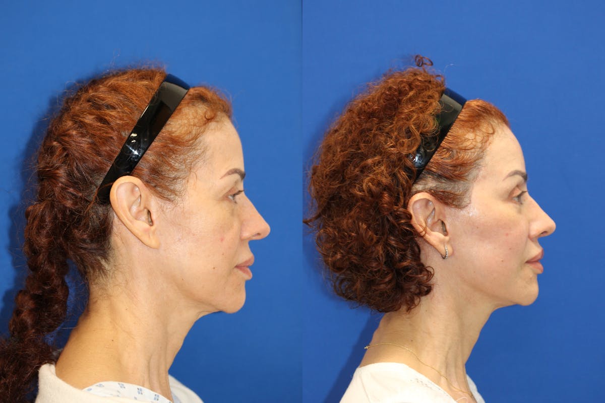 Vertical Restore® / Facial Rejuvenation Before & After Gallery - Patient 153265762 - Image 3
