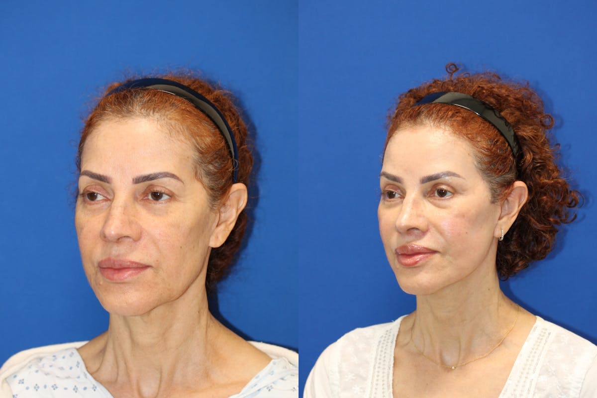 Vertical Restore® / Facial Rejuvenation Before & After Gallery - Patient 153265762 - Image 4