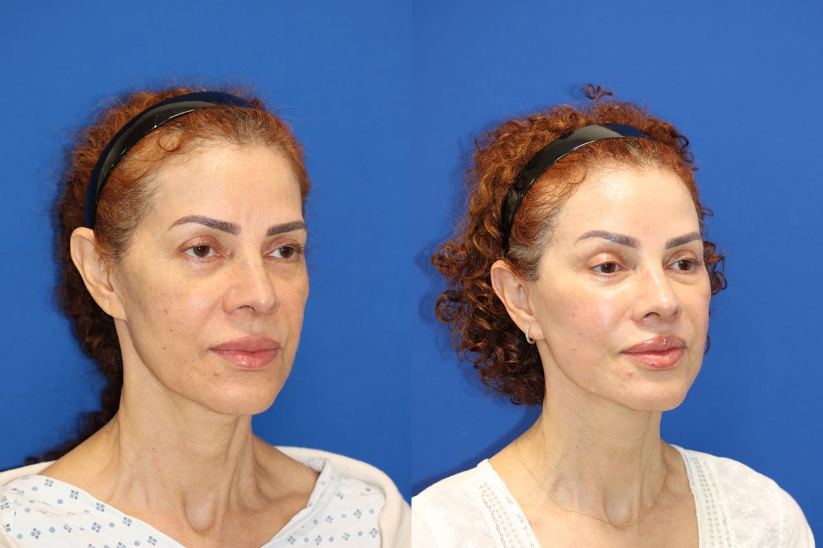 Vertical Restore® / Facial Rejuvenation Before & After Gallery - Patient 153265762 - Image 2