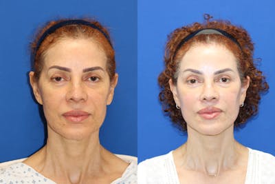 Vertical Restore® / Facial Rejuvenation Before & After Gallery - Patient 153265762 - Image 1