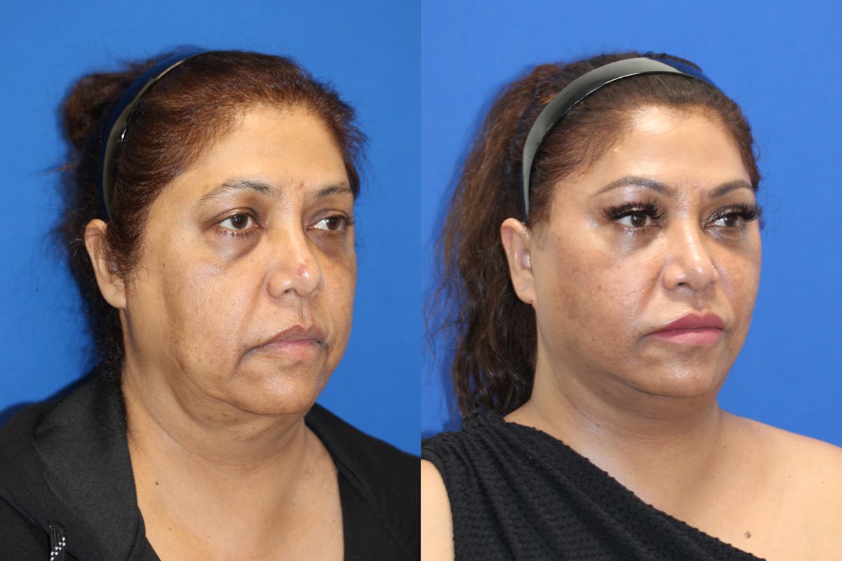 Vertical Restore® / Facial Rejuvenation Before & After Gallery - Patient 180865042 - Image 2