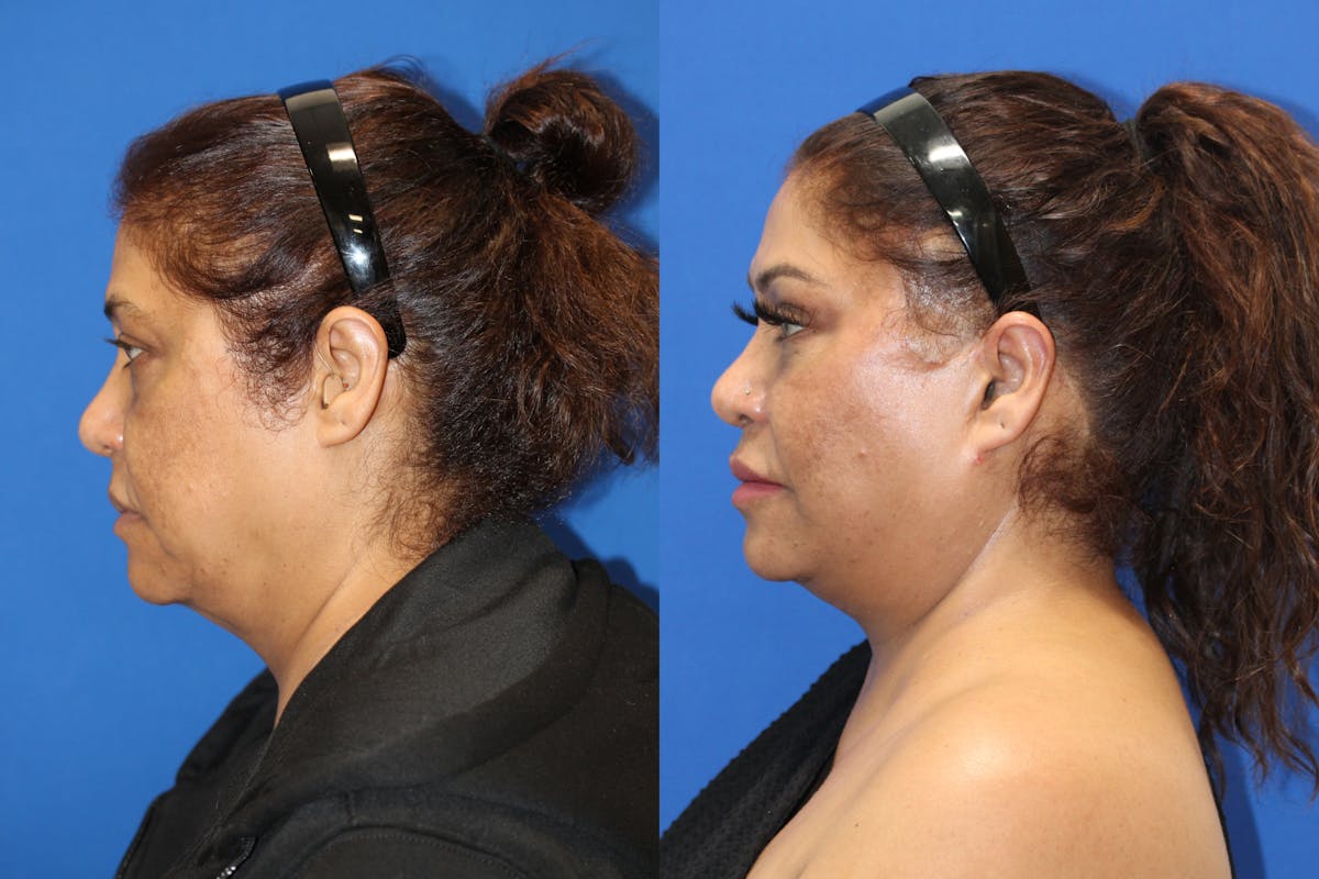 Vertical Restore® / Facial Rejuvenation Before & After Gallery - Patient 180865042 - Image 5
