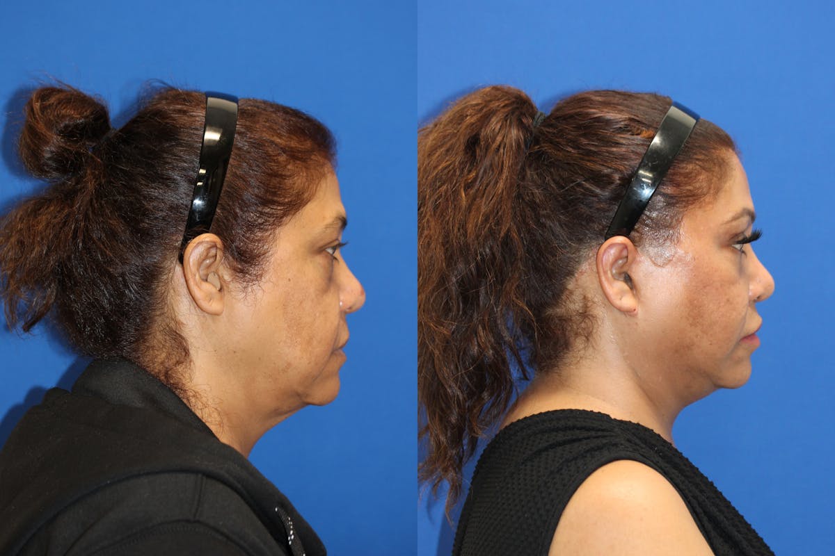 Vertical Restore® / Facial Rejuvenation Before & After Gallery - Patient 180865042 - Image 3