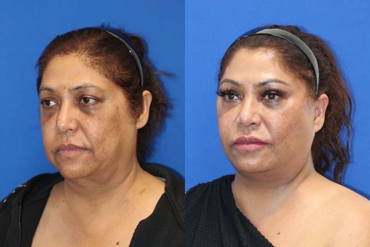 Vertical Restore® / Facial Rejuvenation Before & After Gallery - Patient 180865042 - Image 4
