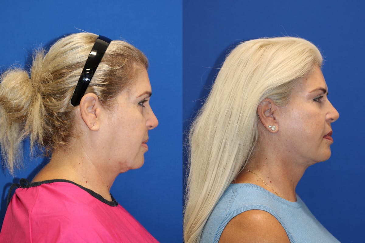 Vertical Restore® / Facial Rejuvenation Before & After Gallery - Patient 180866701 - Image 3