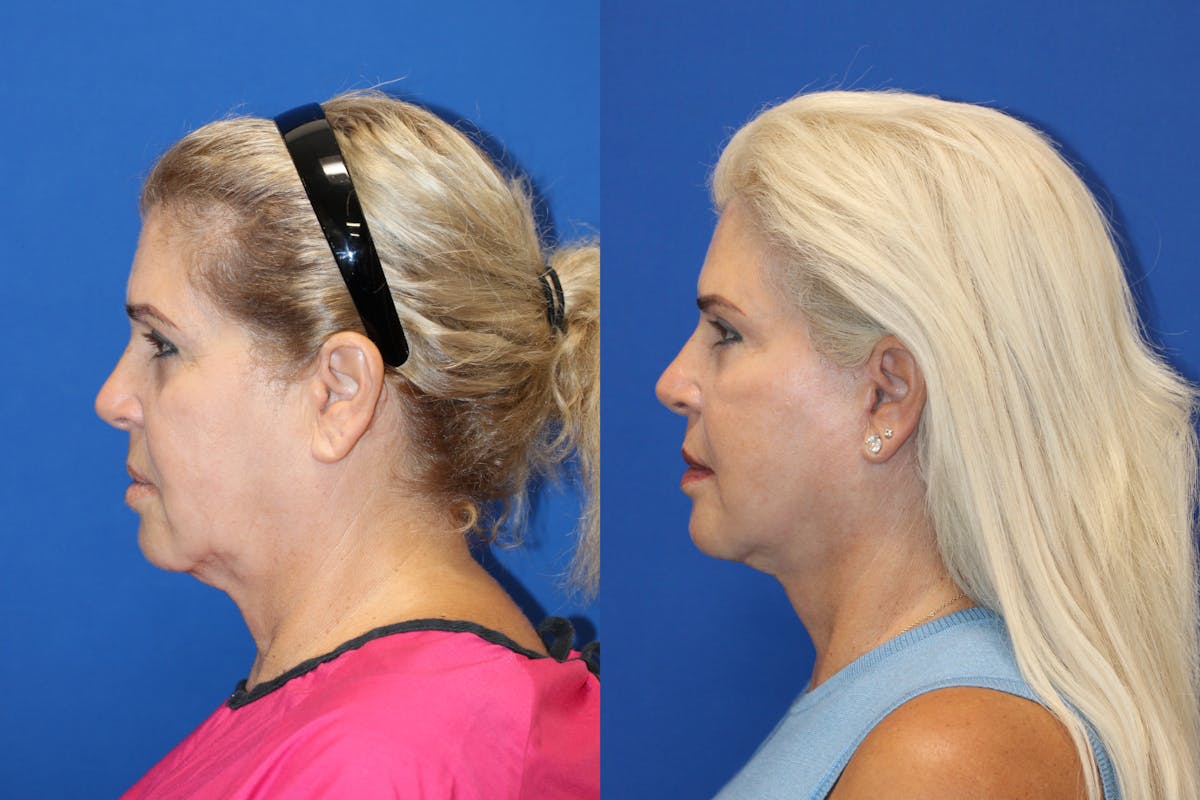 Vertical Restore® / Facial Rejuvenation Before & After Gallery - Patient 180866701 - Image 5