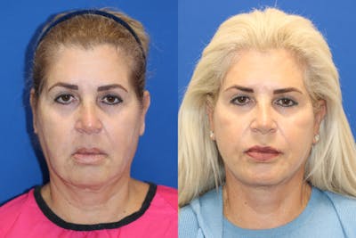 Vertical Restore® / Facial Rejuvenation Before & After Gallery - Patient 180866701 - Image 1