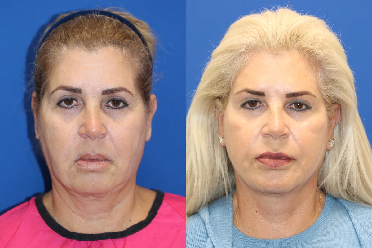 Vertical Restore® / Facial Rejuvenation Before & After Gallery - Patient 180866701 - Image 1