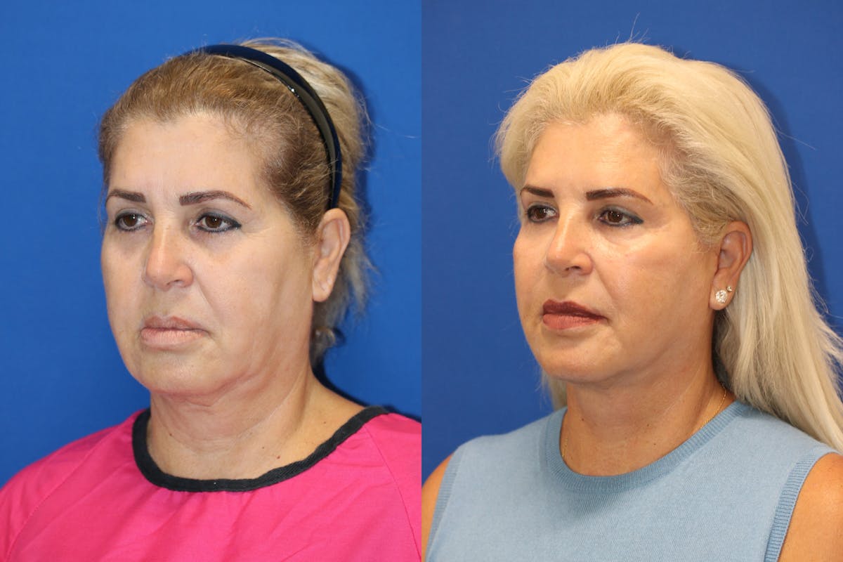 Vertical Restore® / Facial Rejuvenation Before & After Gallery - Patient 180866701 - Image 4