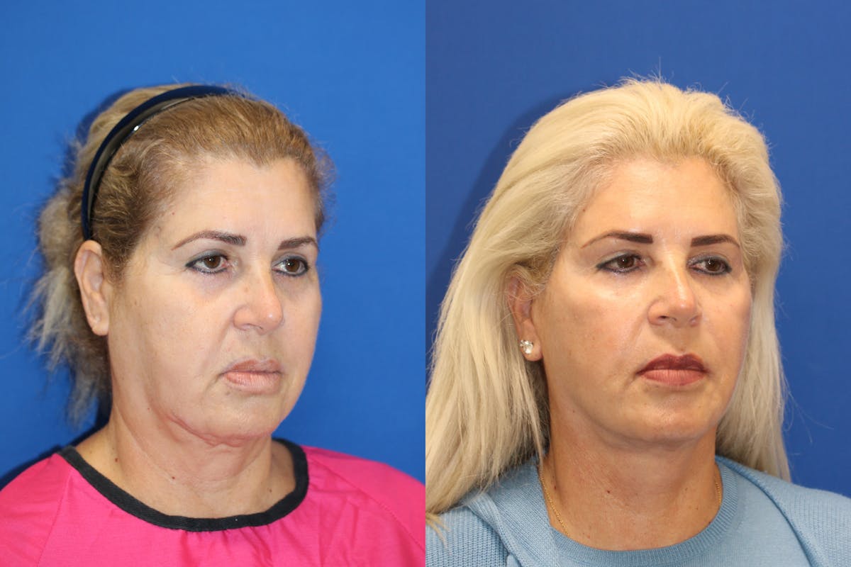 Vertical Restore® / Facial Rejuvenation Before & After Gallery - Patient 180866701 - Image 2