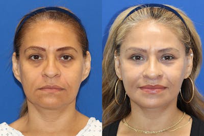 Vertical Restore® / Facial Rejuvenation Before & After Gallery - Patient 330064 - Image 1