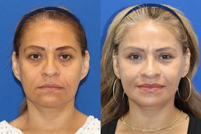 Vertical Restore® / Facial Rejuvenation Before & After Gallery - Patient 330064 - Image 1