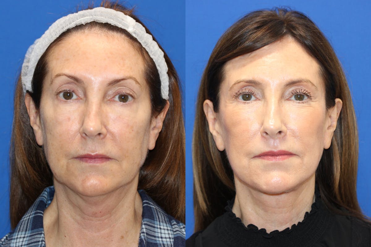 Vertical Restore® / Facial Rejuvenation Before & After Gallery - Patient 797123 - Image 1