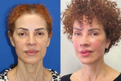 Vertical Restore® / Facial Rejuvenation Before & After Gallery - Patient 185444 - Image 1