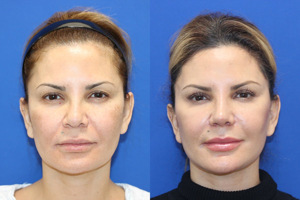 Vertical Restore® / Facial Rejuvenation Before & After Gallery - Patient 231253 - Image 1