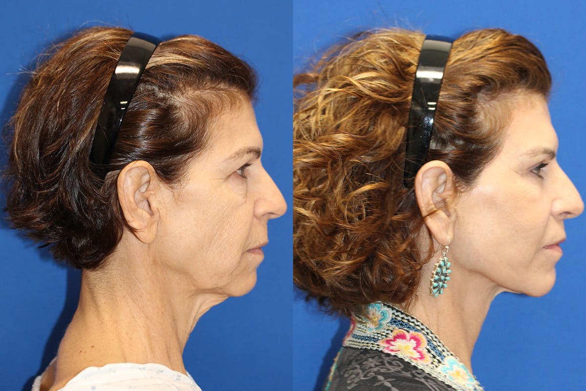 Vertical Restore® / Facial Rejuvenation Before & After Gallery - Patient 328629 - Image 2