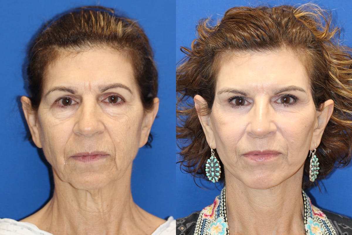Vertical Restore® / Facial Rejuvenation Before & After Gallery - Patient 328629 - Image 1