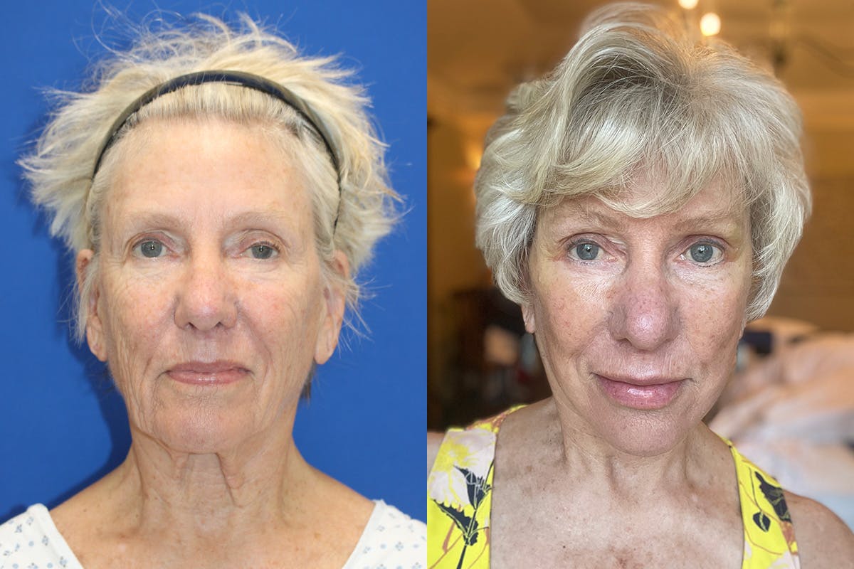 Vertical Restore® / Facial Rejuvenation Before & After Gallery - Patient 139131 - Image 1