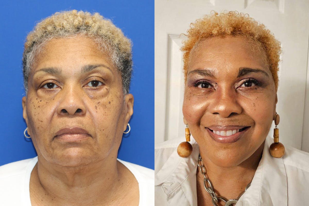Vertical Restore® / Facial Rejuvenation Before & After Gallery - Patient 301776 - Image 1