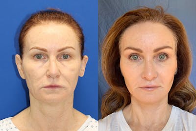 Vertical Restore® / Facial Rejuvenation Before & After Gallery - Patient 154094 - Image 1