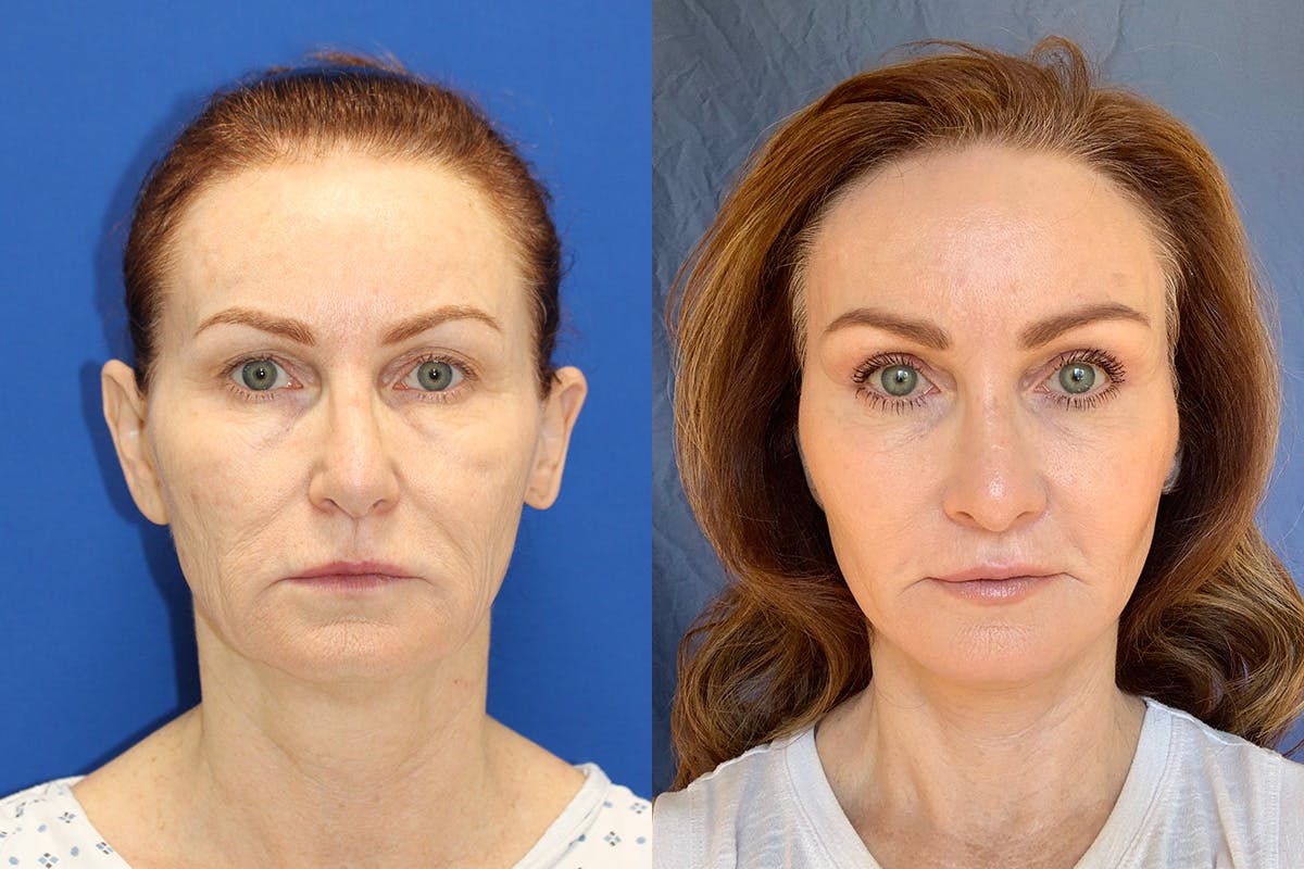 Vertical Restore® / Facial Rejuvenation Before & After Gallery - Patient 154094 - Image 1
