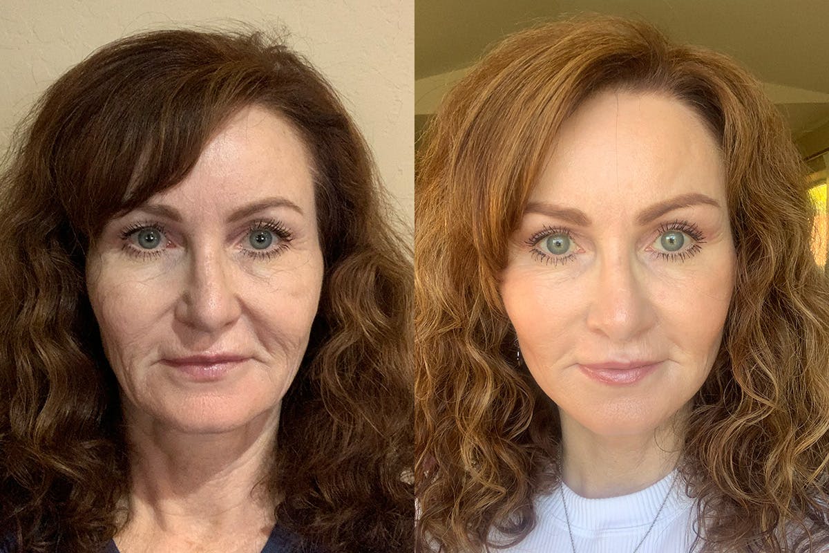Vertical Restore® / Facial Rejuvenation Before & After Gallery - Patient 154094 - Image 2