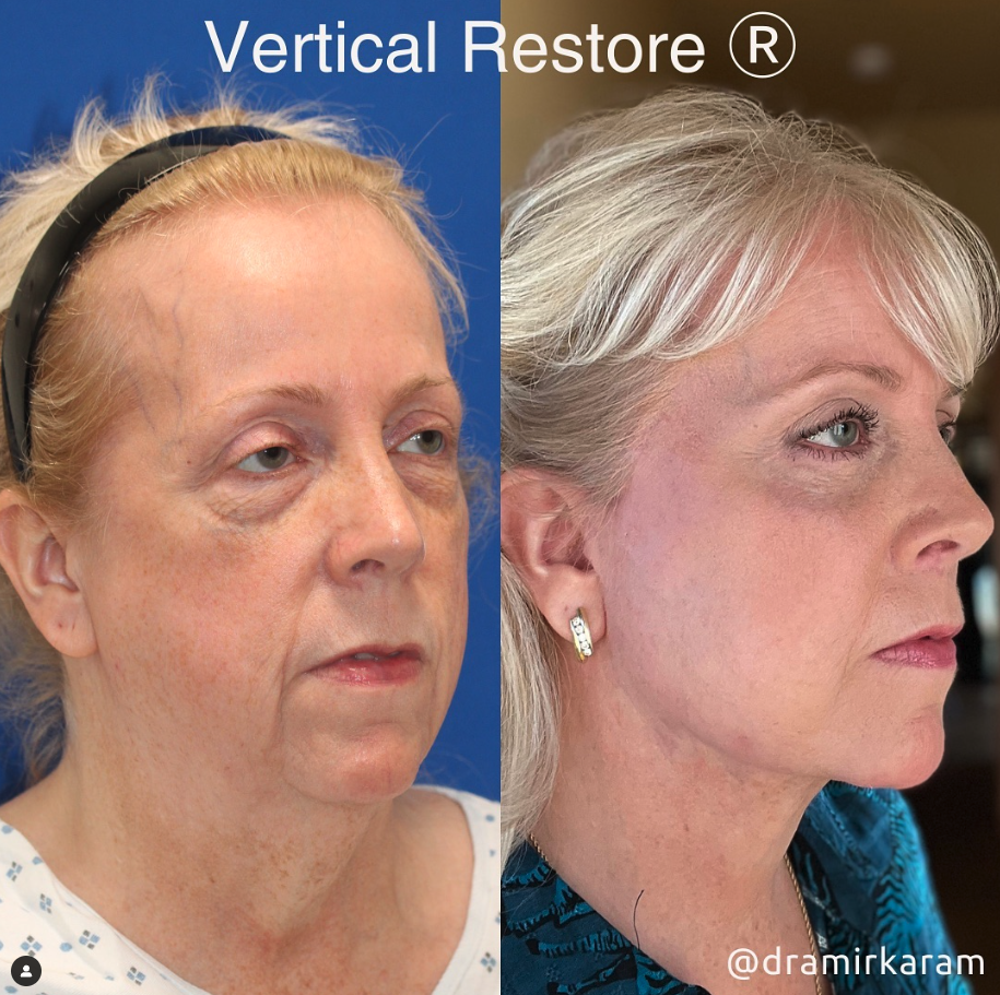 Best Natural Looking Facelift 2023, Blog