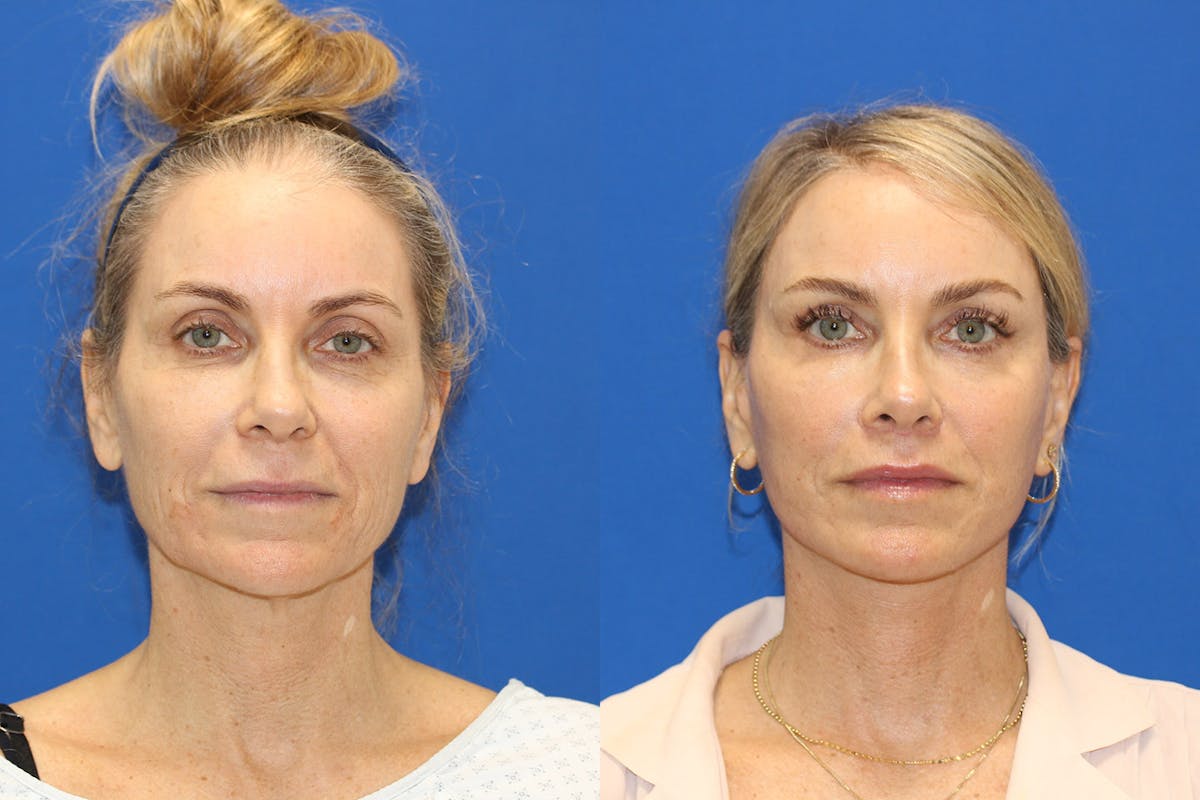 Vertical Restore® / Facial Rejuvenation Before & After Gallery - Patient 700702 - Image 1