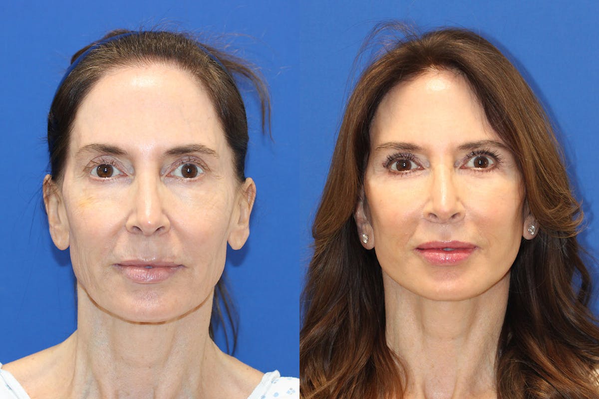 Vertical Restore® / Facial Rejuvenation Before & After Gallery - Patient 469419 - Image 1