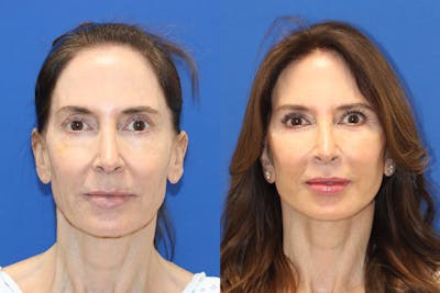 Vertical Restore® / Facial Rejuvenation Before & After Gallery - Patient 469419 - Image 1