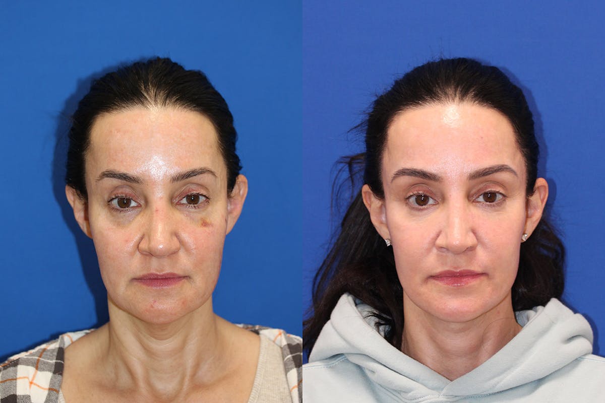 Vertical Restore® / Facial Rejuvenation Before & After Gallery - Patient 234341 - Image 1