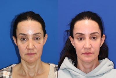 Vertical Restore® / Facial Rejuvenation Before & After Gallery - Patient 234341 - Image 1