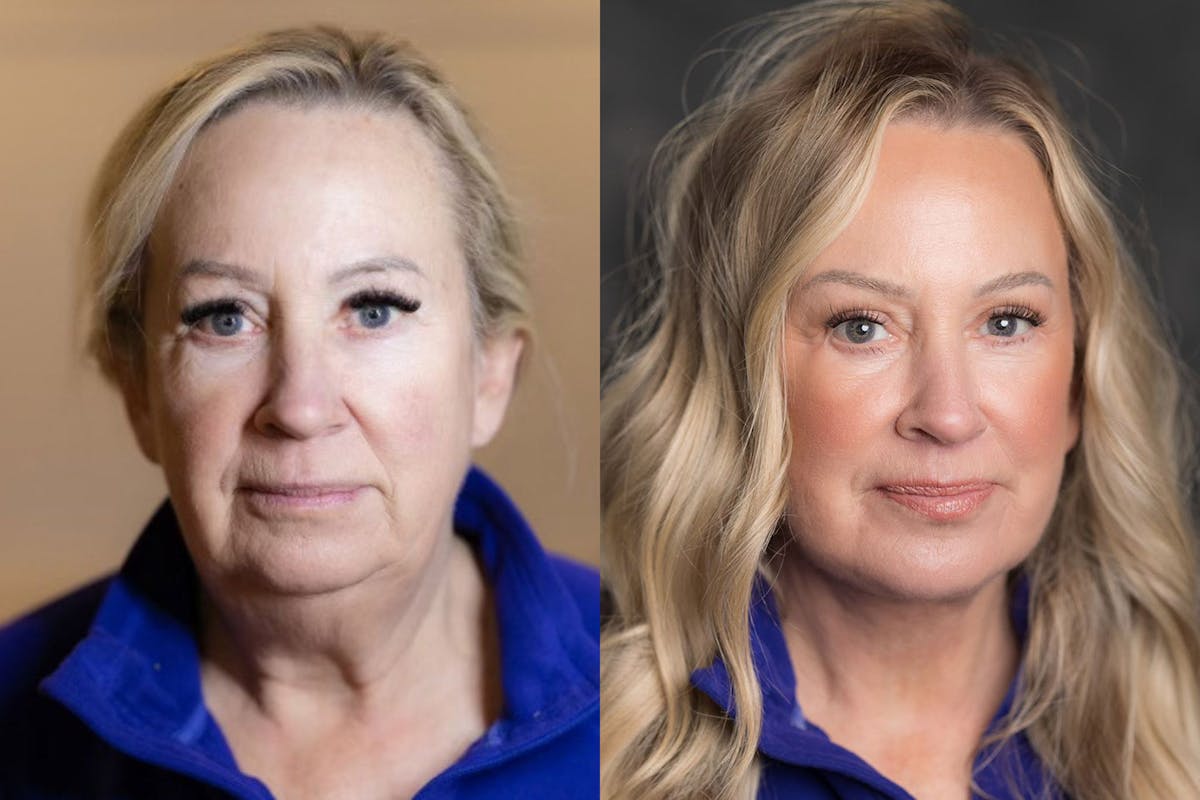 Vertical Restore® / Facial Rejuvenation Before & After Gallery - Patient 123065539 - Image 1