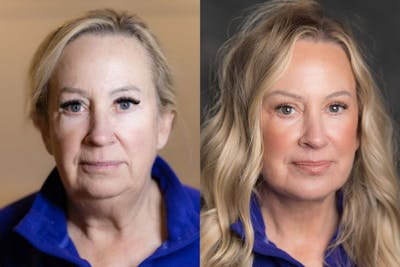 Vertical Restore® / Facial Rejuvenation Before & After Gallery - Patient 123065539 - Image 1