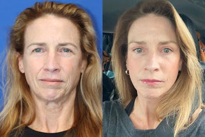 Vertical Restore® / Facial Rejuvenation Before & After Gallery - Patient 209028 - Image 1