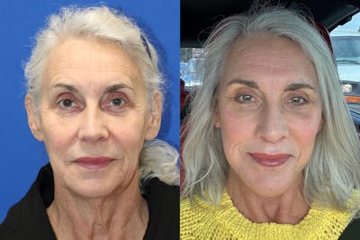 Vertical Restore® / Facial Rejuvenation Before & After Gallery - Patient 304277 - Image 1
