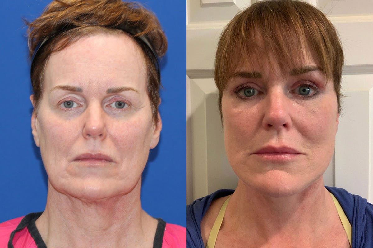 Vertical Restore® / Facial Rejuvenation Before & After Gallery - Patient 326133 - Image 1