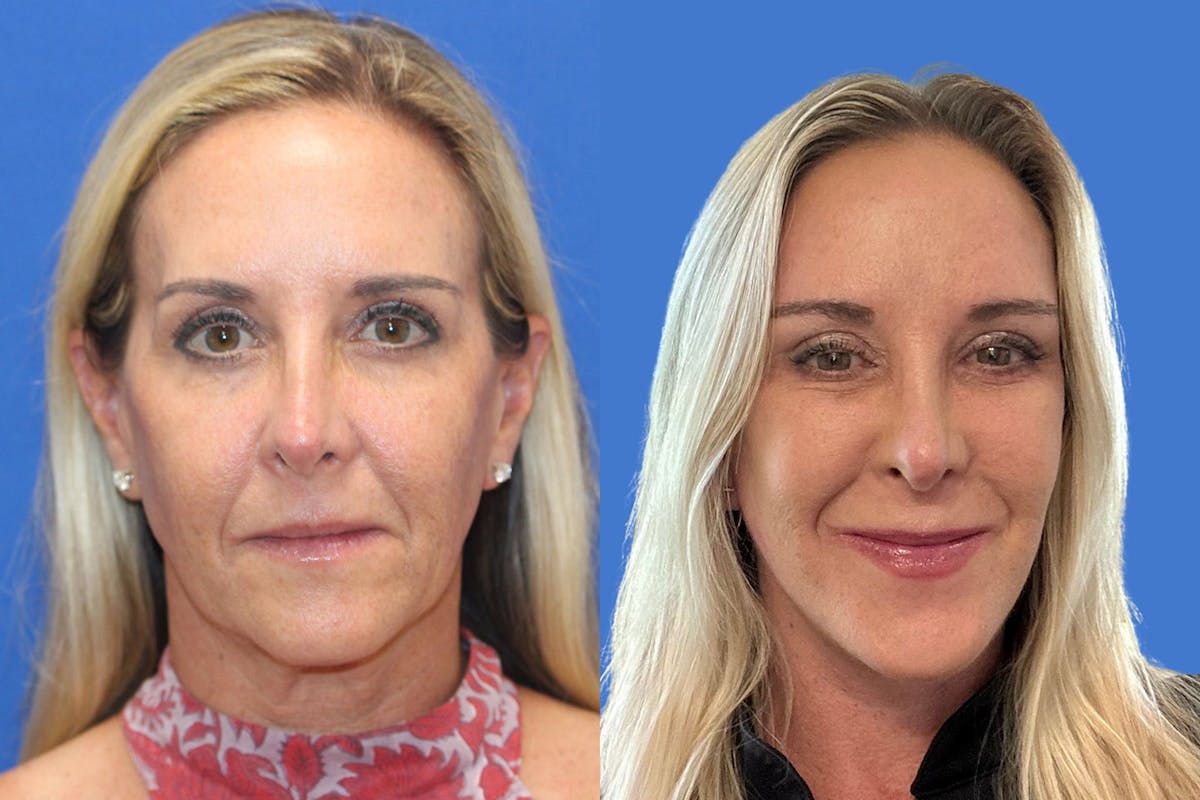 Vertical Restore® / Facial Rejuvenation Before & After Gallery - Patient 283120 - Image 1